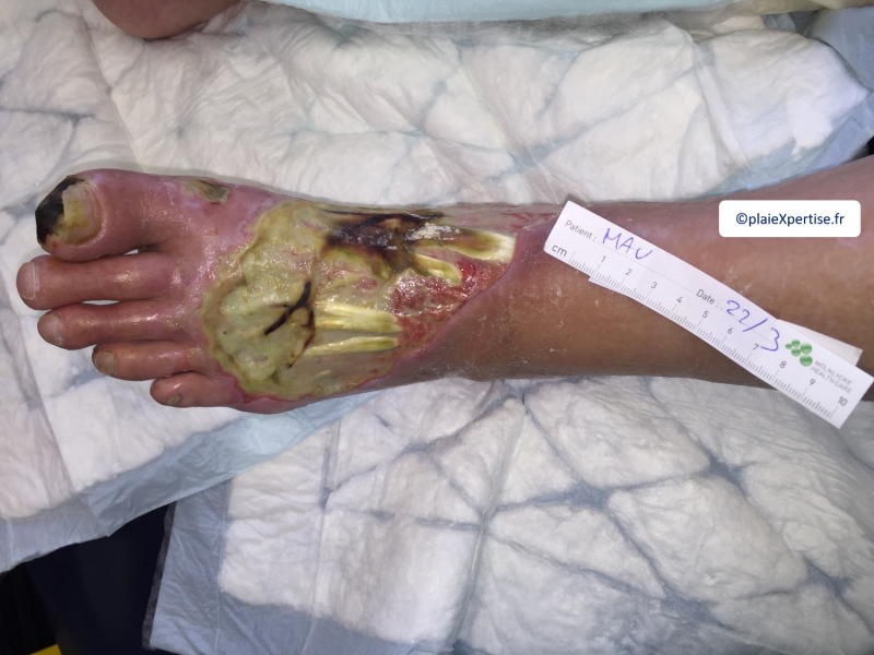 Fichier:Tendon nécrotique humide44.png