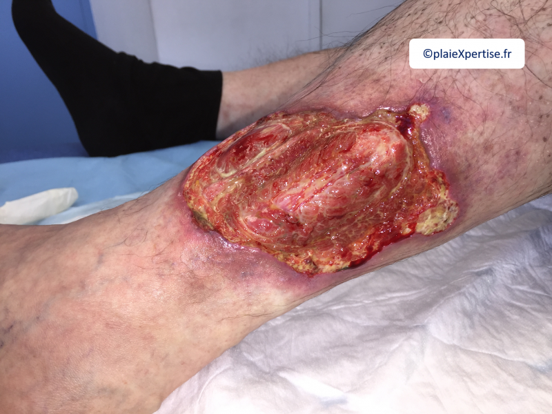 Fichier:Tendon-Voussure6.png