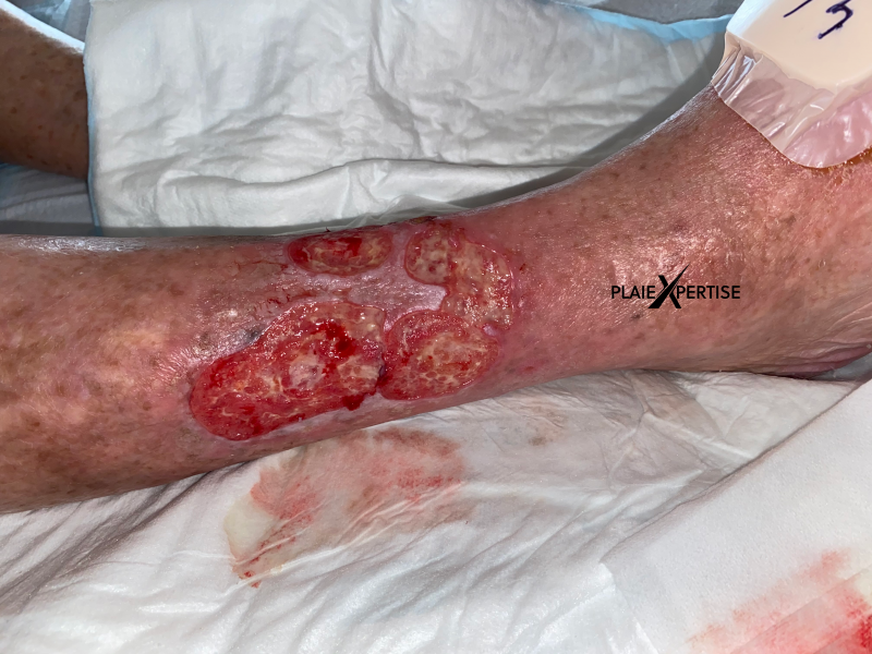 Fichier:Tissu de granulation normal19.png