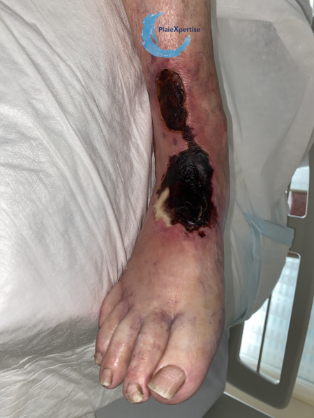 Fichier:Cou de pied60.png