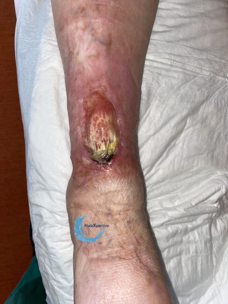 Fichier:Cou de pied97.jpg