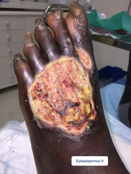 Fichier:Tendon nécrotique sec12.png