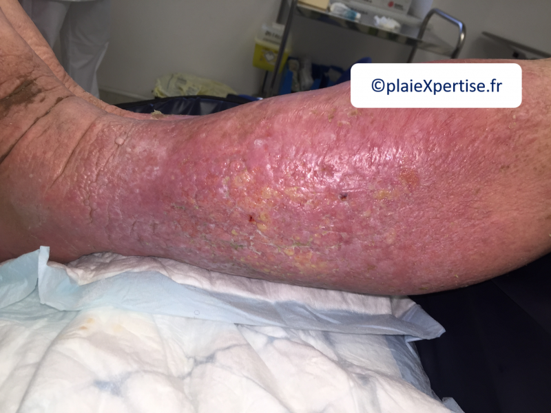 Fichier:Grosses jambes suintantes4.png