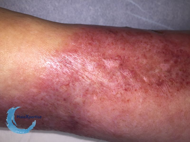 Fichier:Nécrobiose lipoïdique22.jpg