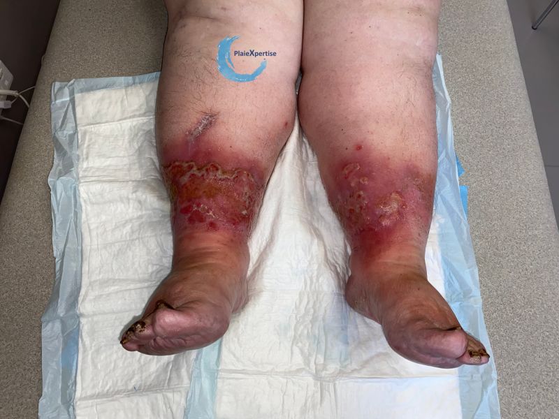 Fichier:Grosses jambes suintantes27.jpg