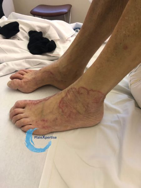 Fichier:Dermatophytie2.jpg