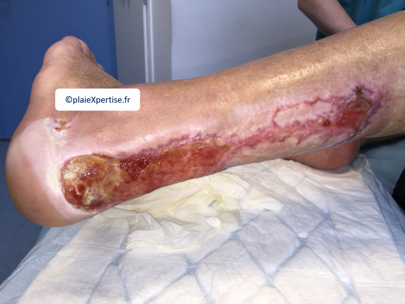 Fichier:Tendon-Reliquat3.png