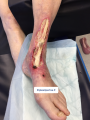 Tendon normal11.png