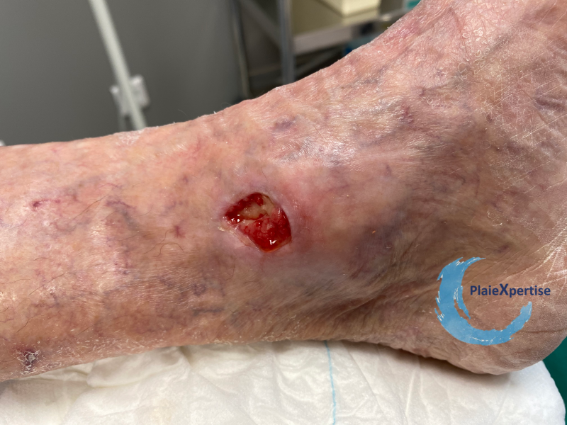 Fichier:Tissu de granulation normal36.png