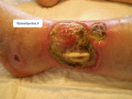 Tendon nécrotique humide8.png