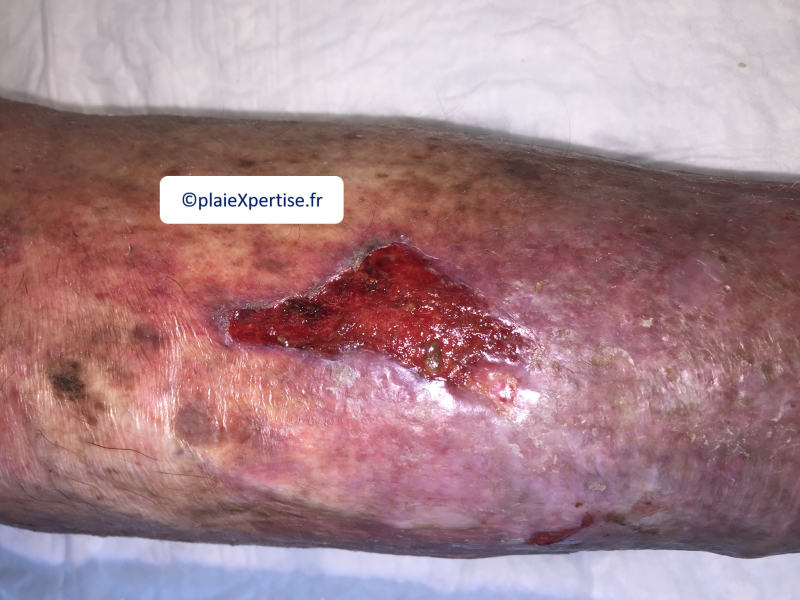 Fichier:Tissu de granulation normal12.png