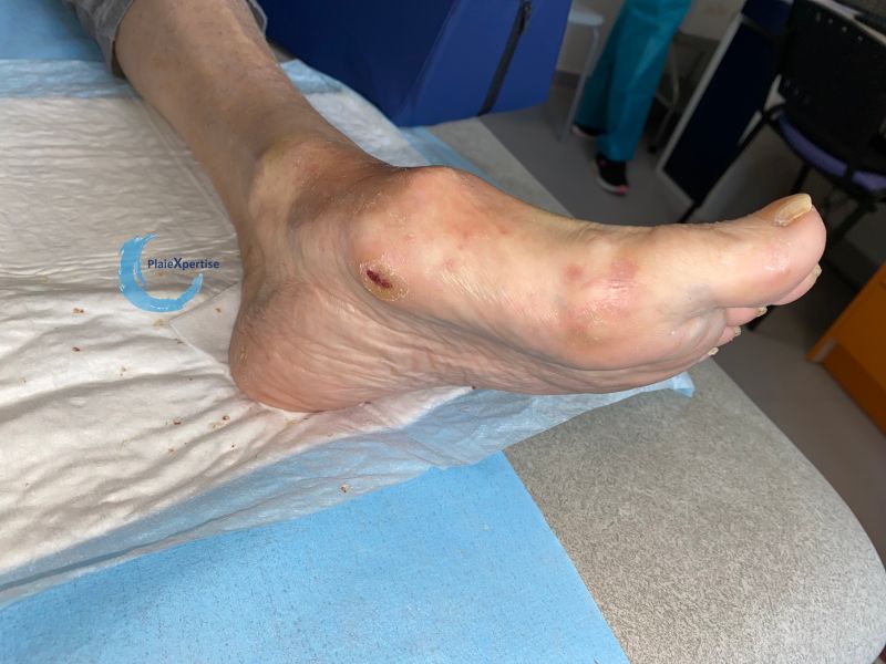Fichier:Pied de Charcot46.jpg
