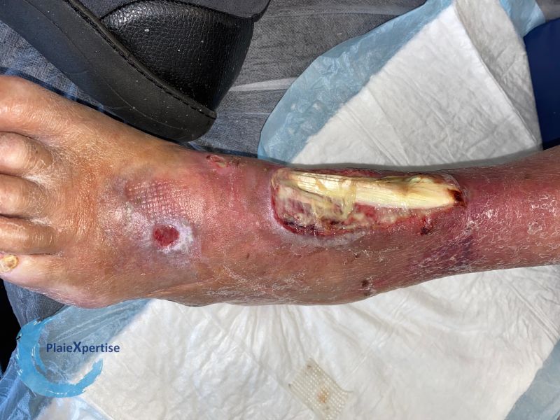 Fichier:Tendon nécrotique humide79.jpg