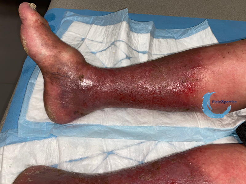 Fichier:Dermiteocre55.png