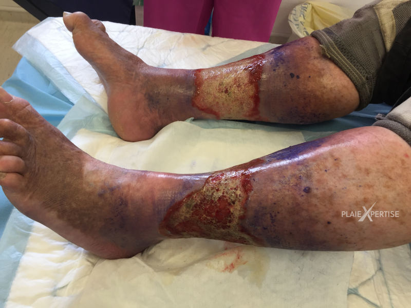 Fichier:Grosses jambes suintantes21.png