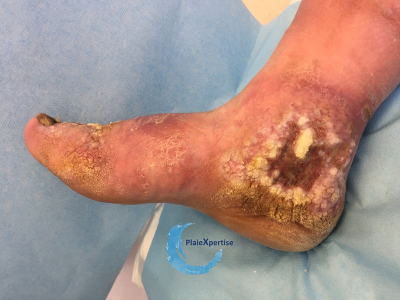 Fichier:Lymphoedème52.jpg
