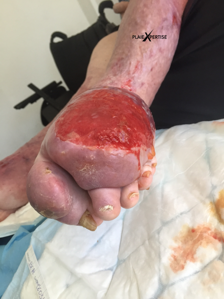 Fichier:Lymphoedème pied17.png