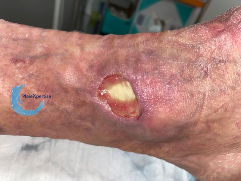 Fichier:Tendon normal35.jpg