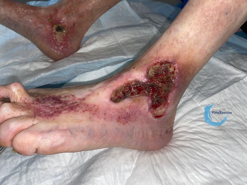 Fichier:Tissu de granulation inflammatoire58.jpg