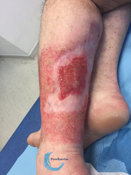 Fichier:Epidermisation6.jpg