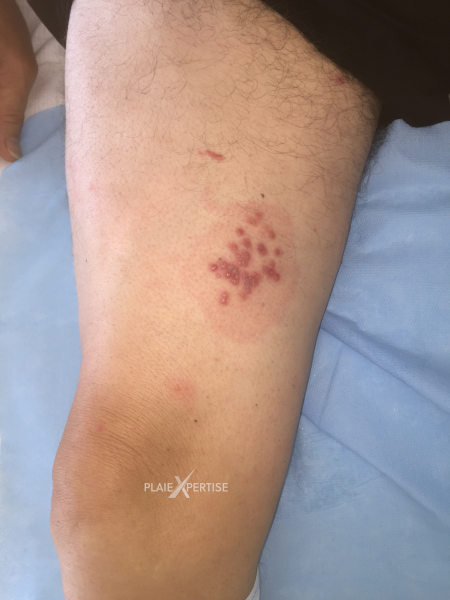 Fichier:Herpes et zona2.png