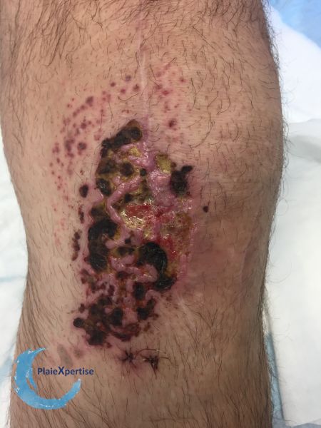 Fichier:Pyoderma gangrenosum51.jpg
