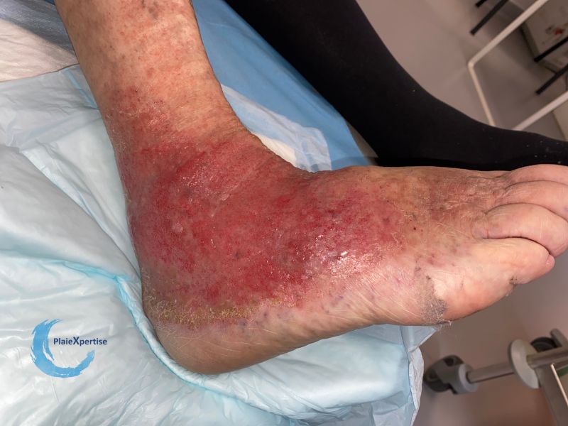 Fichier:Eczéma140.jpg