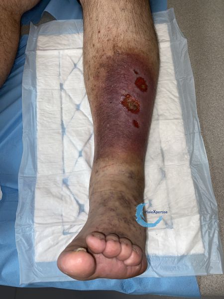 Fichier:Hypodermite chronique53.jpg