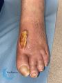 Tendon nécrotique humide76.jpg