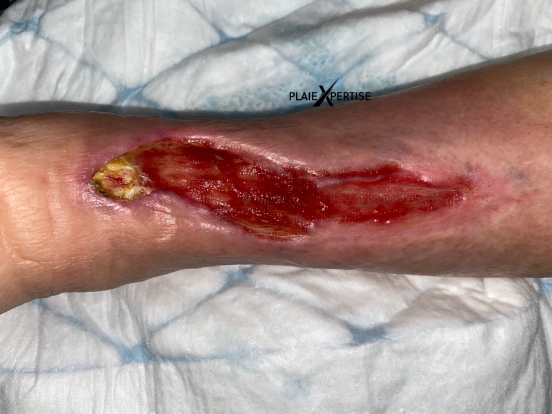 Fichier:Tissu de granulation normal32.png