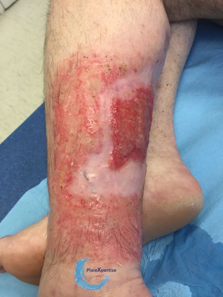Fichier:Epidermisation7.jpg
