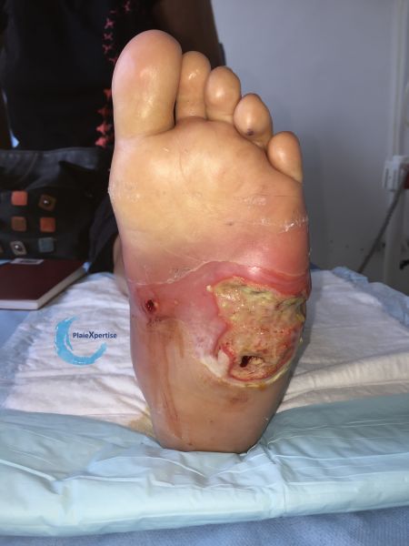 Fichier:Pied de Charcot50.jpg