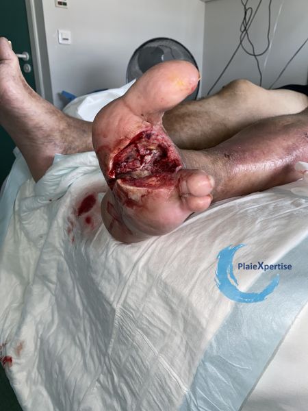 Fichier:Amputation8.jpg