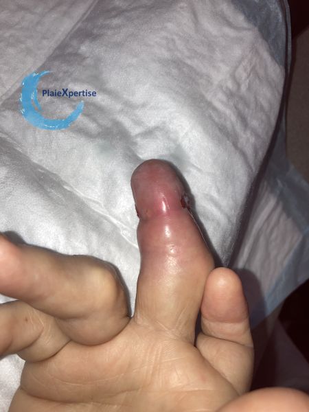 Fichier:Goutte et tophus34.jpg