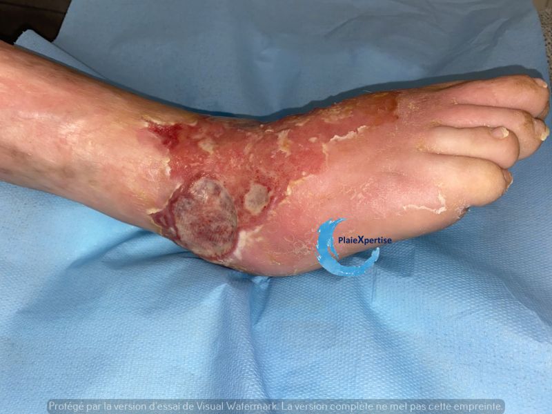 Fichier:Cou de pied107.jpg