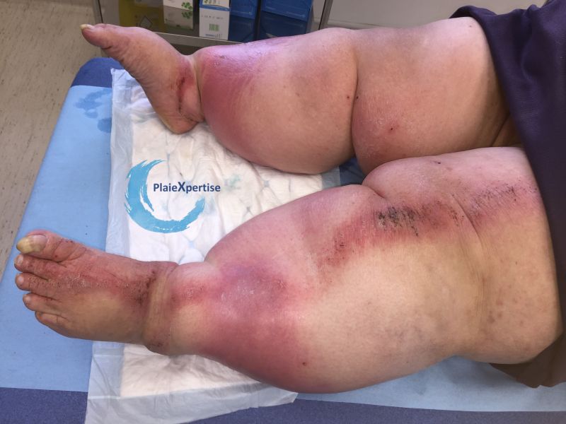 Fichier:Lymphoedème67.jpg