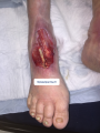 Tendon normal23.png