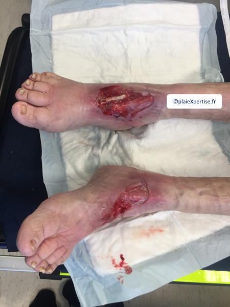 Fichier:Cou de pied26.png