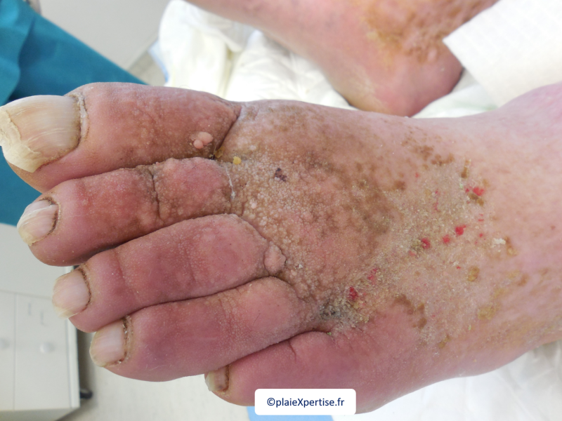 Fichier:Lymphoedème pied11.png
