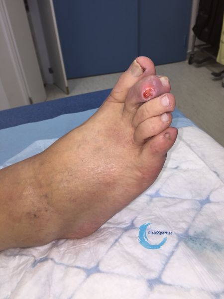 Fichier:Pied goutteux2.jpg