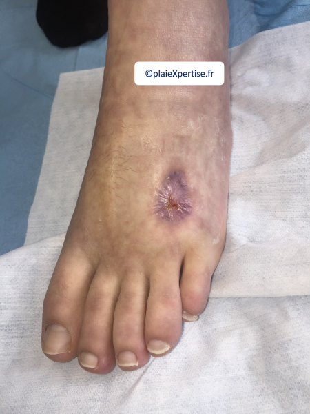 Fichier:Cou de pied21.png