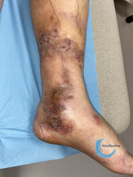 Fichier:Dermiteocre61.png