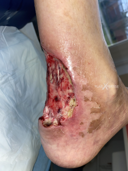 Fichier:Tendon-Reliquat15.png
