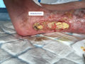 Tendon nécrotique humide2.png