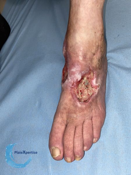 Fichier:Tendon nécrotique humide77.jpg