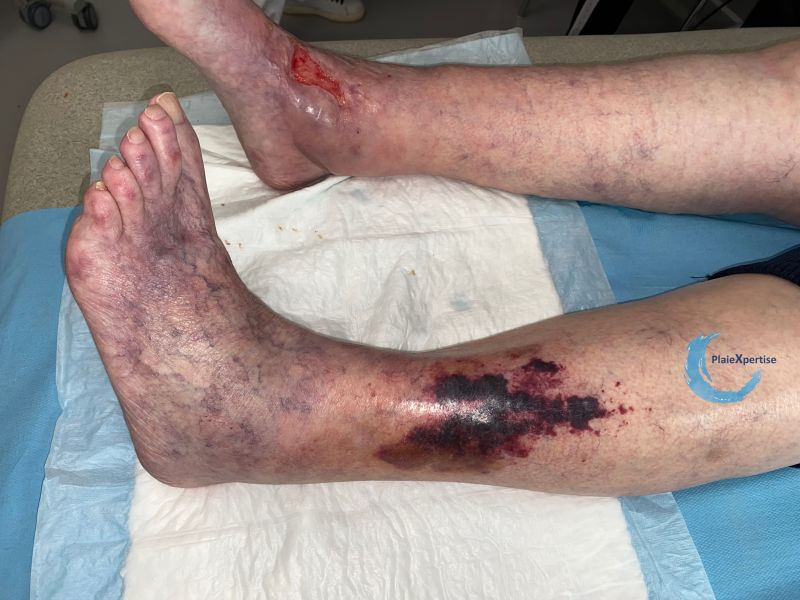Fichier:Dermatoporose91.jpg