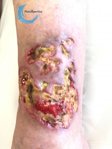 Fichier:Pyoderma gangrenosum27.jpg