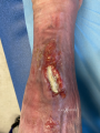 Tendon-Reliquat14.png