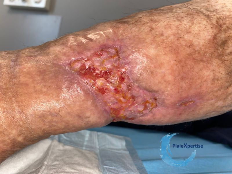Fichier:Epidermisation16.jpg