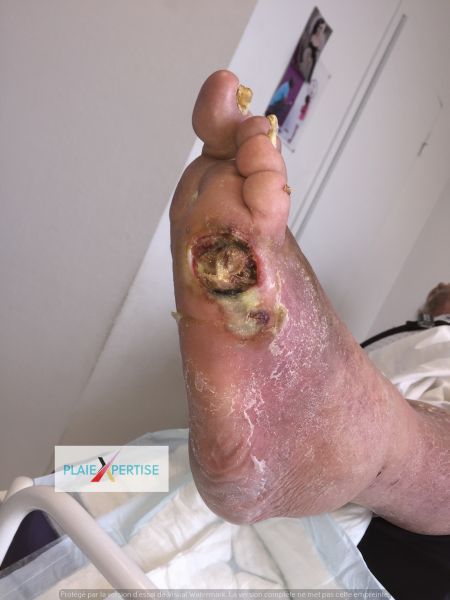 Fichier:Nécrose humide Pied 8.jpg